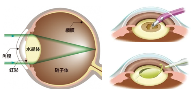 白内障手術のイメージ