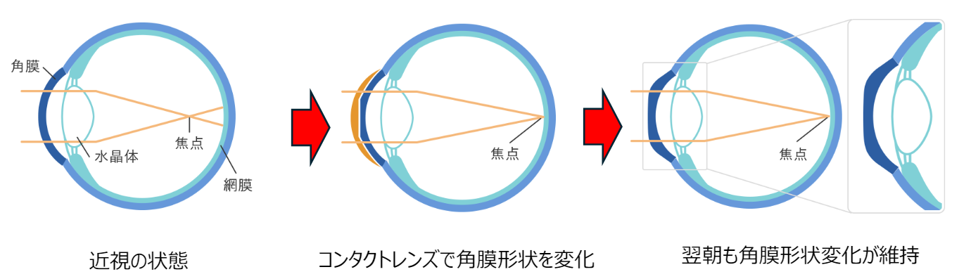 オルソケラトロジー
